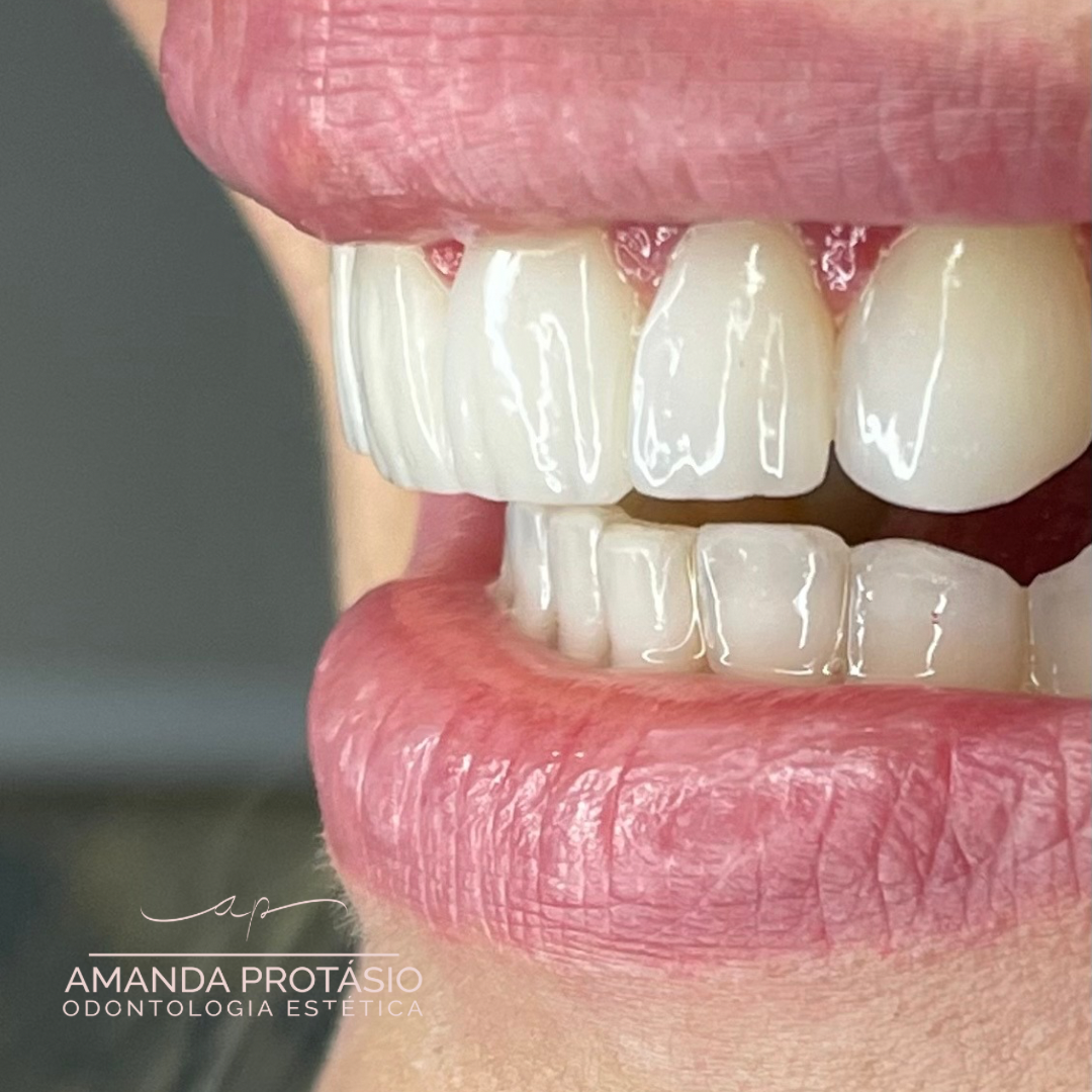 Detalhe lateral de um sorriso com dentes de aspecto natural e gengiva saudável